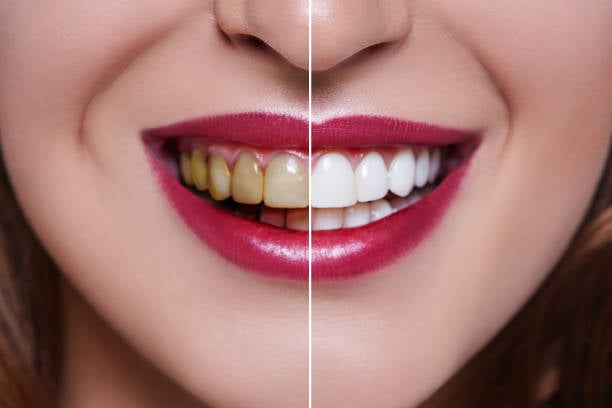 牙齒黃是因為牙齒茶垢嗎？（圖片來源：pexels）